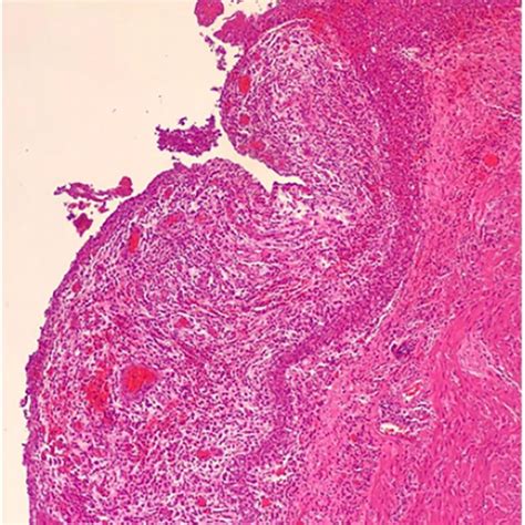 Photomicrograph Section Of Perforated Acute Appendicitis Haematoxylin