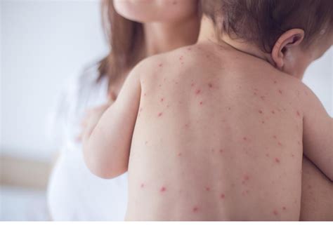 Measles Cases Reported In Kansas City Area