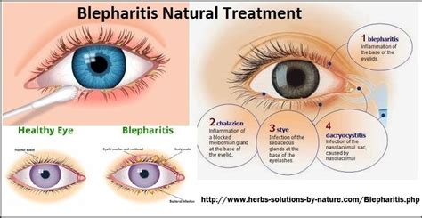 4 Home Base Natural Treatments For Blepharitis Blepharitis Natural