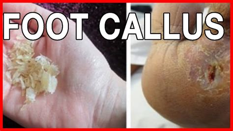 You may not be able to identify the exact cause. How to Prevent Calluses and What Cause Callus on Feet ...