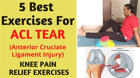Acl Injury Partial Tear Treatment Acl Grade 2 Rehab Exercises