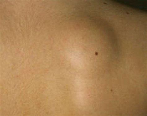 The Ultimate Guide For Lipoma Causes Symptoms Diagnosis And Treatment