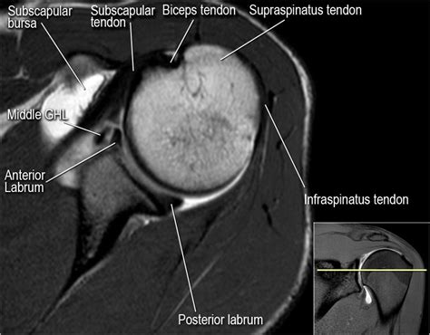 Where Is The Insertion Of The Supraspinatus