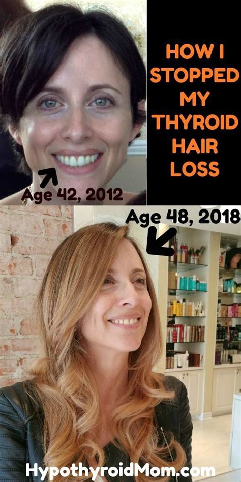 According to some experts, ferritin levels of at least 40 ng/ml are required to stop hair loss, while levels of at least 70 ng/ml are needed for hair regrowth. 10 Things that Stopped My Thyroid Hair Loss | Hypothyroid Mom
