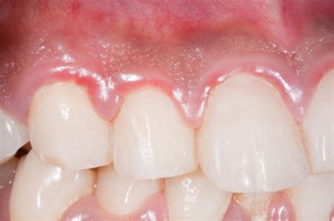 Bright And Dark Red Gums Its Causes And Treatment Oramd
