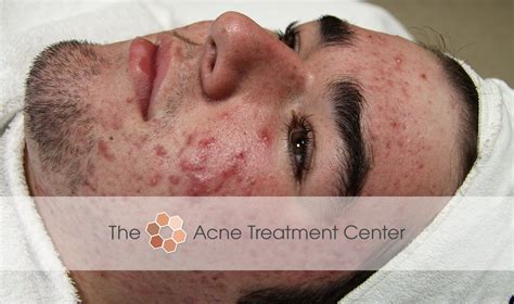 Inflamed Acne Treatment Photo Acne Treatment Center Portland Or