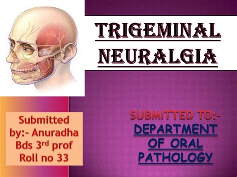 Trigeminal Neuralgia Presentation