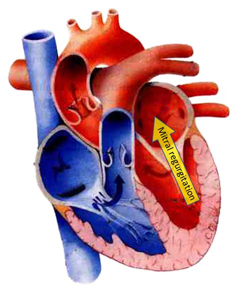 Mitral Heart Valve Problems Images And Photos Finder