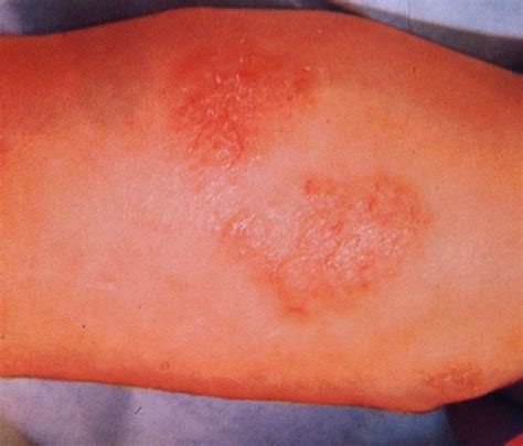 Por lo que en este articulo te daré a conocer cuales son los tipos de alergias en la piel de las cuales es muy importante conocer porque todos debemos saber el por. Manifestaciones dermatológicas de la alergia en bebés y ...
