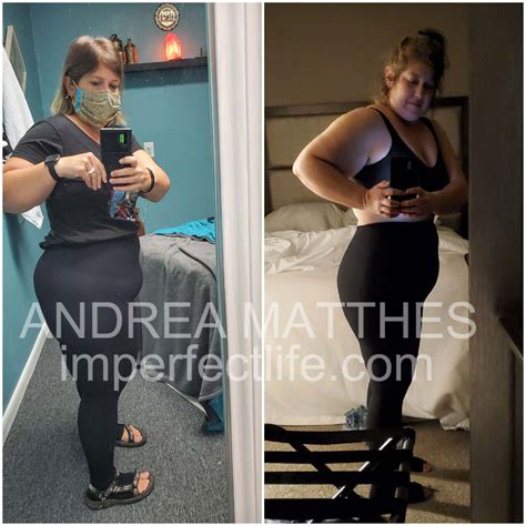 Lipedema Butt Surgery Before And After Imperfect Life