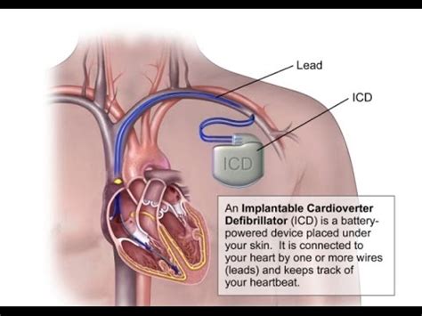 To our knowledge, no imd patient has ever been harmed by a malicious security attack. Things Doctors Don't Tell You About Defibrillators ...