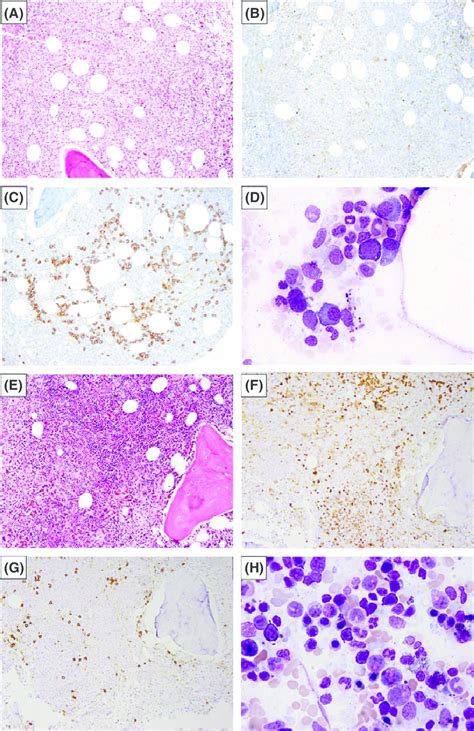 Morphological Features Of Bone Marrow Biopsy Pretreatment And After
