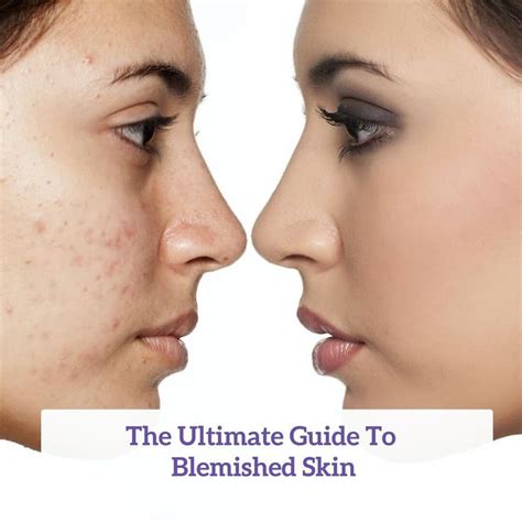 The Ultimate Guide To Blemished Skin Blemished Skin Skin Blemishes