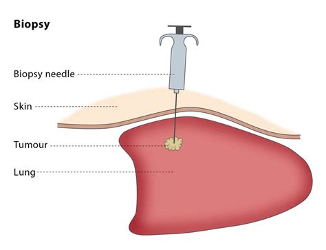 An Image Guided Biopsy Aims To Provide Diagnostic Information By