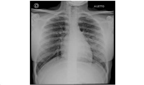 Patients Chest X Ray Interstitial Involvement Marked In Hilar And