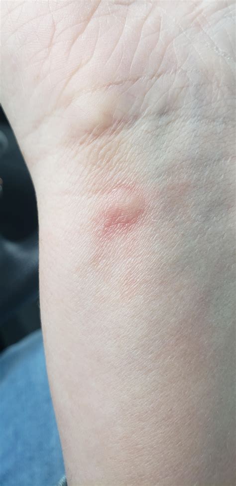 Itchy Red Bump On Wrist Noticed It Yesterday Spot Is Usually Covered