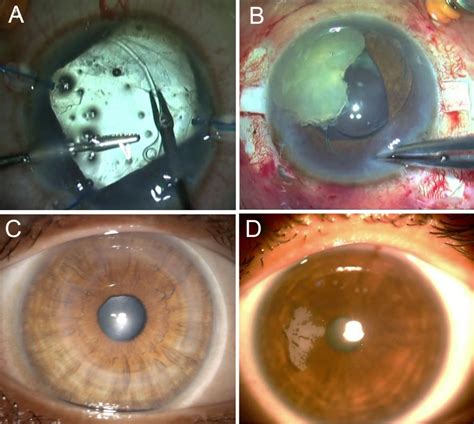 Escrs Complications Of Cataract And Refractive Surgery