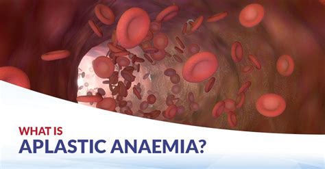 Aplastic Anaemia Cfch Centre For Clinical Haematology