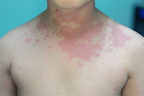 Skin Rashes In Children Causes Treatment And Prevention