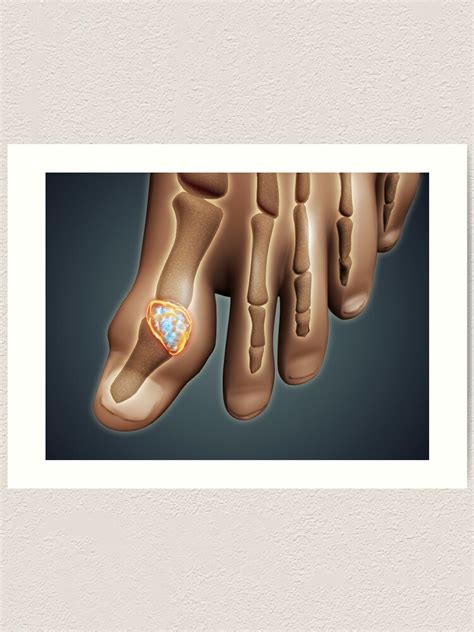 Conceptual Image Of Gout In The Big Toe Art Print By Stocktrekimages