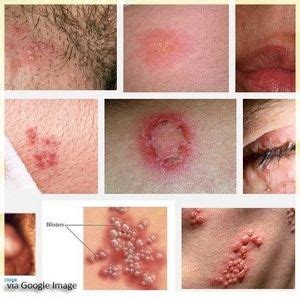 Two herpes subtypes may cause these sores. The symptoms of herpes virus infection | Herpes remedies ...