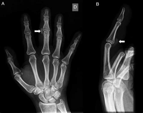 Acute Calcific Periarthritis In Proximal Interphalangeal Joint An