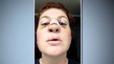 Botched Before And After A Transgender Surgery Addict A Cleft Lip And