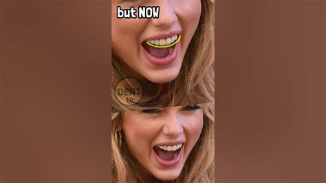 Taylor Swift Teeth Then And Now Before And After Surgery Tooth