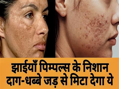 How To Treat Skin Pigmentation Naturally Dahi For Clear Skin Hindi