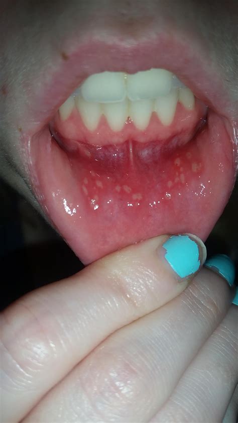 Blister On Tongue Canker Sore On Tongue Tongue Sores