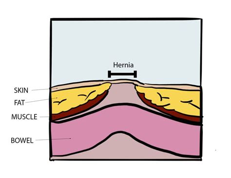 Abdominal Wall Hernia Diagram