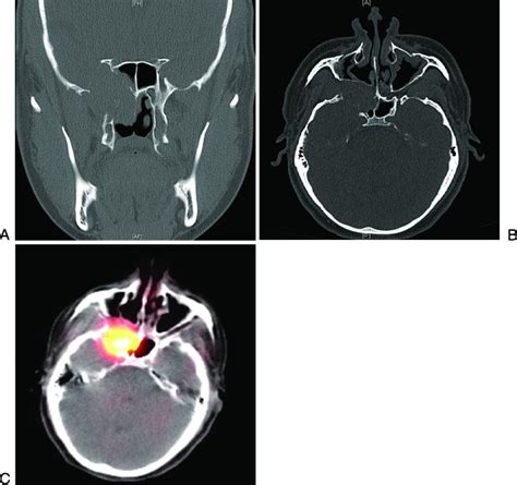 Computed Tomography Ct Of The Sinuses A Coronal And B Axial
