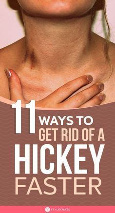 The precautions and the measures should be done accordingly in order to avoid any kind of bad reaction. How To Get Rid Of A Hickey 11 Simple Ways: Hickeys or love ...
