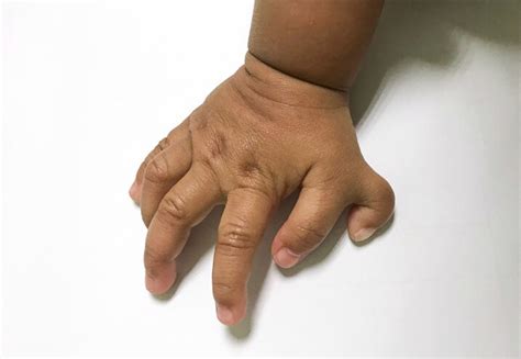 Limb Deformity