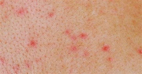 This gallery shows various herpes pictures, and also a couple of images of conditions that may mimic a herpes infection like chickenpox or canker sores. Complete Understanding of Genital Herpes in Women ~ Herpes ...