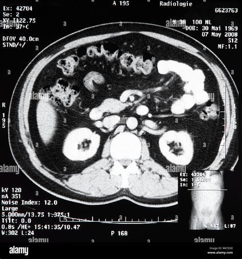 Ct Scan Abdomen Hi Res Stock Photography And Images Alamy