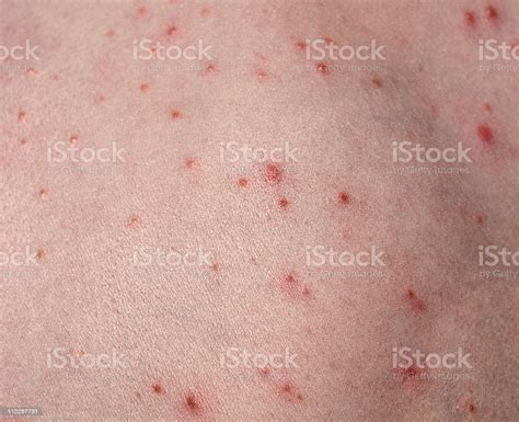 Folliculitis On Childs Back Stock Photo Download Image Now Acne