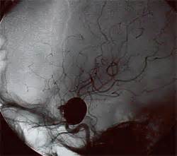 They may never find out they have a brain aneurysm, or it may be found by accident when their brain is scanned for some other reason. Cerebral Aneurysm - Symptoms, Diagnosis and Treatments