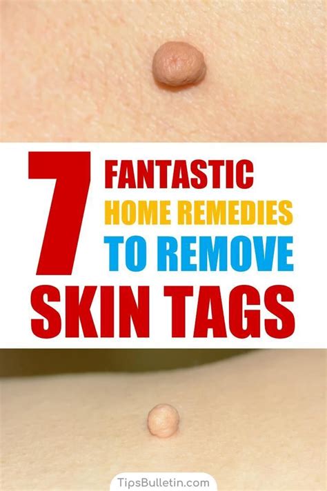 7 fantastic home remedies to remove skin tags skin tag removal skin tag skin tags on face