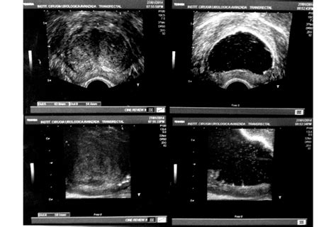 Transrectal Ultrasound Of Prostate Telegraph