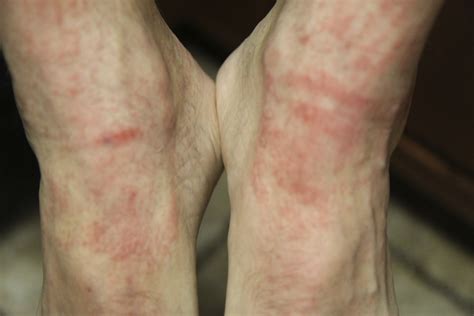 What Causes A Rash On My Feet The Best Porn Website