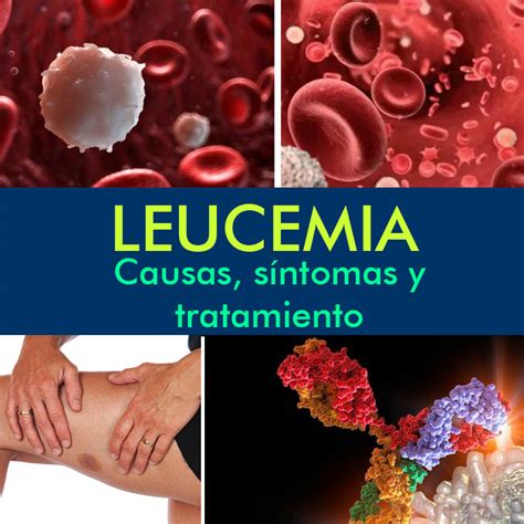 Leucemia Causas Síntomas Y Tratamiento La Guía De Las Vitaminas