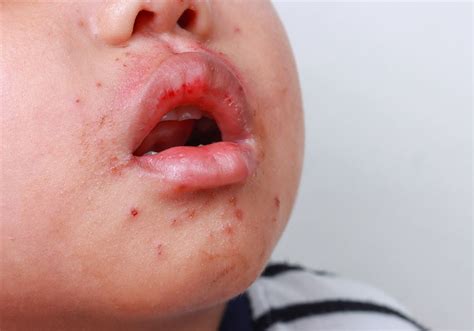 Hand Foot And Mouth Disease Strikes Pittsburgh Area Schools