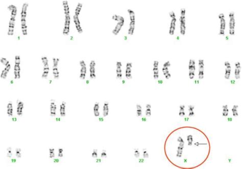Karyotype Of Turner S Syndrome SLE Subject Demonstratin Open I