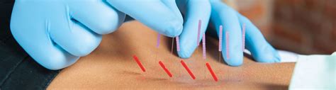 dry needling information and faq summit physical therapy