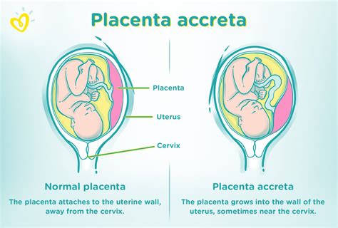 Placenta Accreta Symptoms Causes And Risks Pampers
