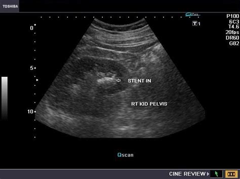 Cochinblogs Ultrasound Imaging Of Ureteral Stent
