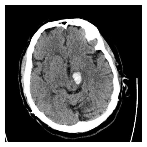 Repeat Axial Head Ct Without Contrast Enhancement Done 24 Hours After