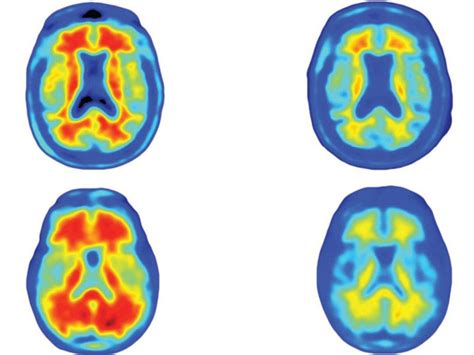 After entering into a partnership with biogen in 2007. Aducanumab - Reduces plaques in Alzheimer's disease ...
