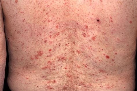 How To Tell The Difference Between Bed Bug Bites And Chicken Pox Whatodi